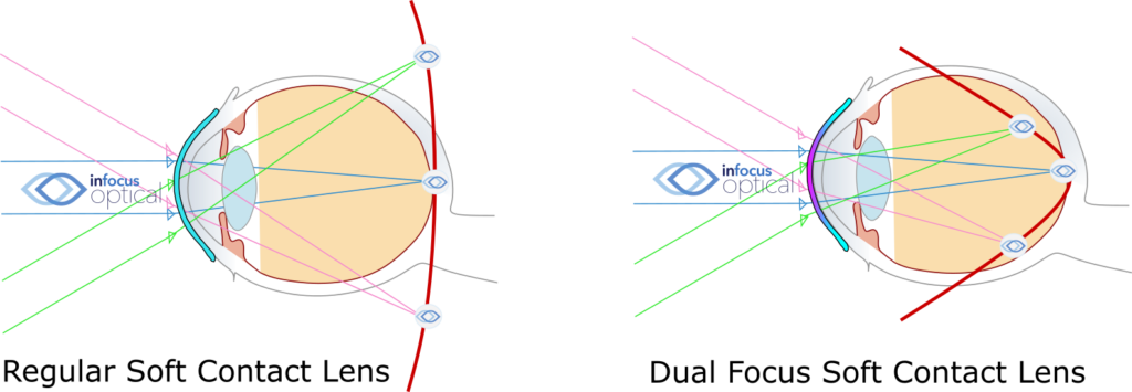 How Do Dual Focus Soft Contact Lenses Work In Myopia Control?
